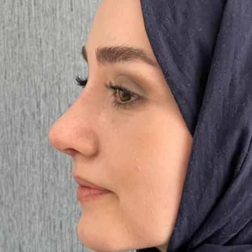 عملية تجميل الأنف صور قبل وبعد